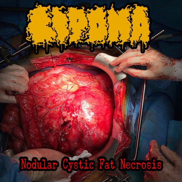 Lipoma : Nodular Cystic Fat Necrosis (CDr, Comp)
